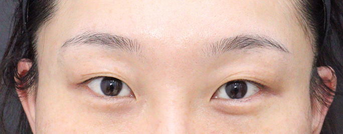 다른곳을 또  하게된다면 베리굿성형외과 먼저 와볼것같아요. 강추!!