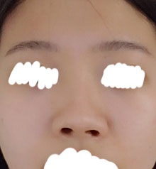 ​첫코수술 잘못되서 코가휘어있고 높이도 낮고 콧구멍도 짝짝이 총체적 난국 이였는데