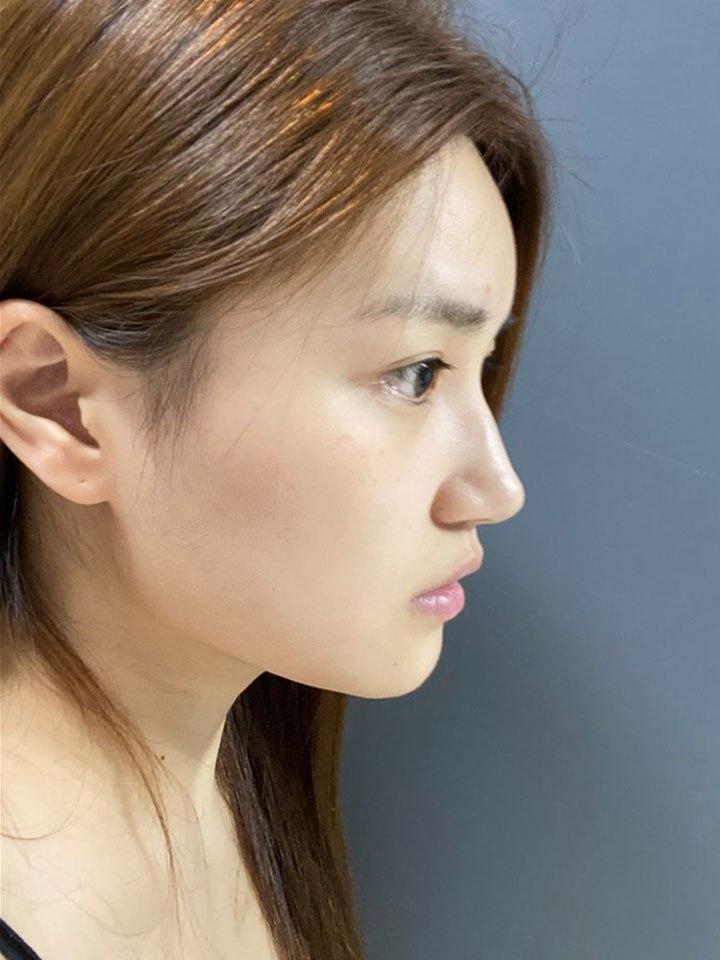 임영민원장님이랑 수술전 후 사진보면서 수술 잘됐다고 맞장구치고 옴ㅋㅋ