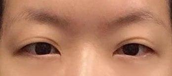 안녕하세요. 벌써 수술한지 6개월 지났네요.