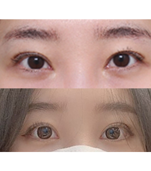 수술한지 한달 조금 넘었어요