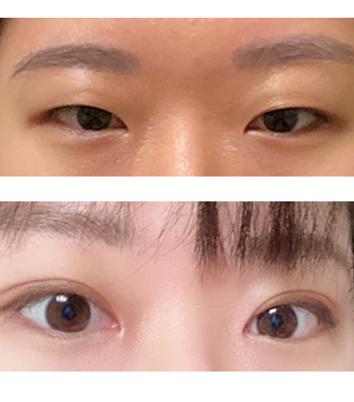 베리굿성형외과 강추드림니당^ㅡ^