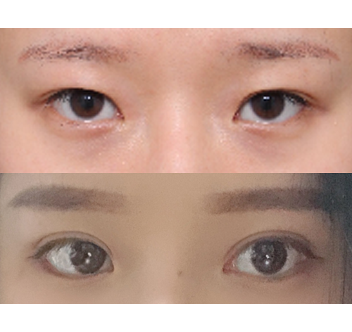 저는 예전에 절개 쌍수 이후 점점 들어가는 쌍커플이 내내 스트레스였어서 재수술을 선택했어요