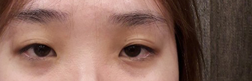 베리굿 성형외과에서 첫 눈 수술 받았습니다