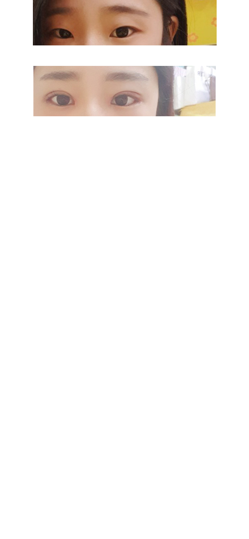 저는 쌍꺼풀, 자연유착, 앞트임, 뒷트임했어요~~^^