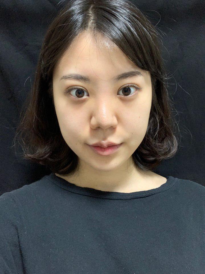 시간이 지나니 붓기도 다빠져서 자연스럽고 어색한 부분없이 자리 잡아서 너무 좋아요. 베리굿~!!