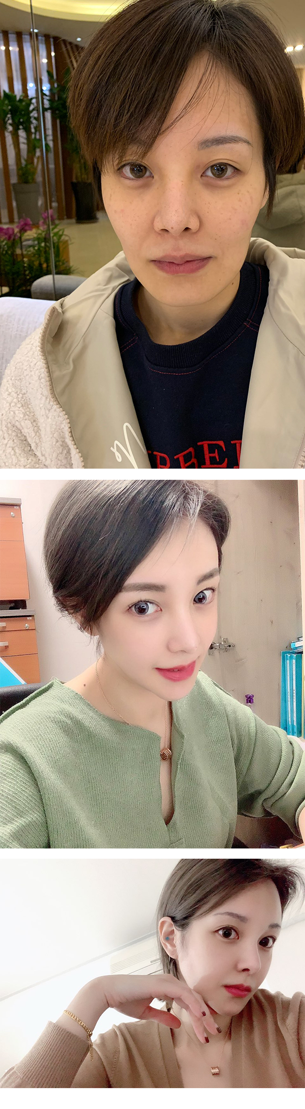 벌써 1년 가까이 되가는 것 같아요 얼굴이 좀 울툴불퉁한것도 많이 좋아졌구요 ㅋㅋ 얼굴라인이 좀 나아지니까 셀카도 잘 찍고 있어요 ㅋㅋㅋ