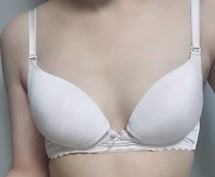 產後做了隆乳手術！