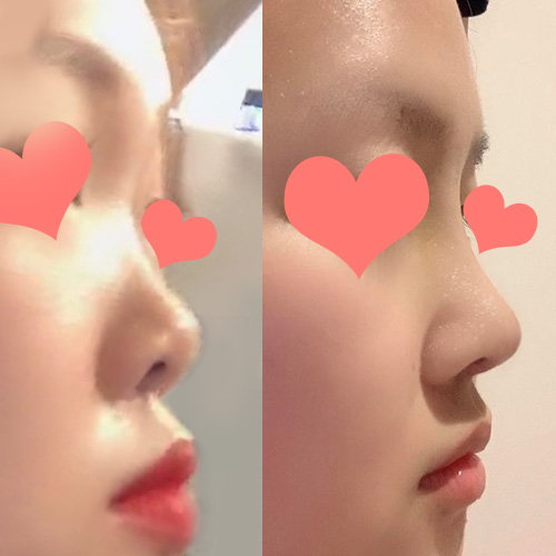 隆鼻手術後記!!