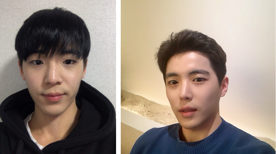 做了眼部矯正和開眼角，以及鼻部手術。