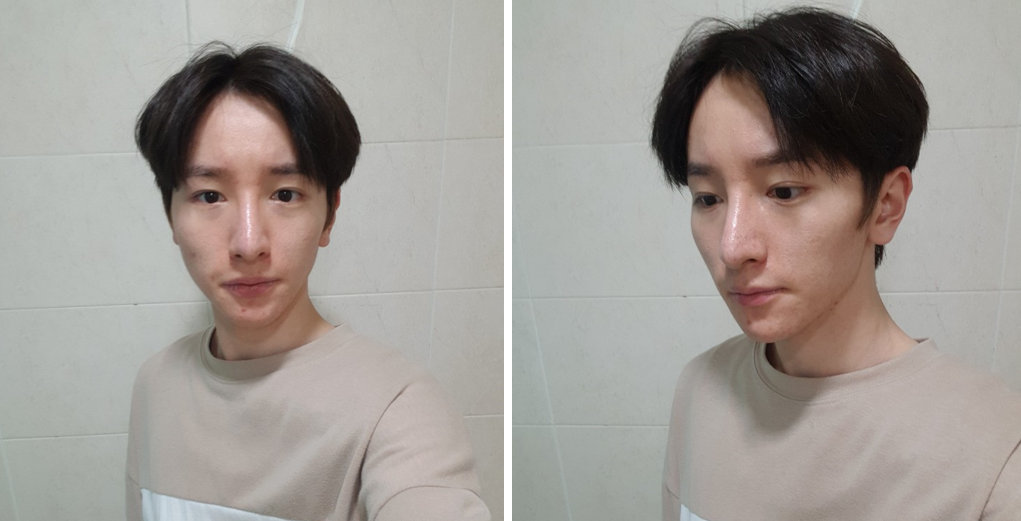 顏面輪廓、隆鼻、全臉脂肪移植