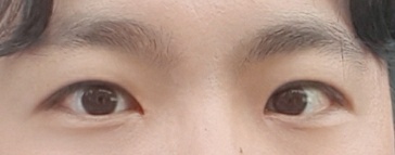 做了男性眼部矯正（包含開眼頭，切開）~！！