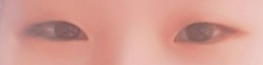 我在Jayjun整形外科朴亨俊院長那裡做了雙眼皮眼部矯正手術！！