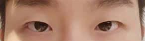 男生眼部整形10天~後記（眼部矯正（非切割）、開眼頭）