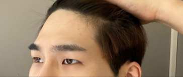 做了眼型矯正和額頭拉提的'5個月後記！