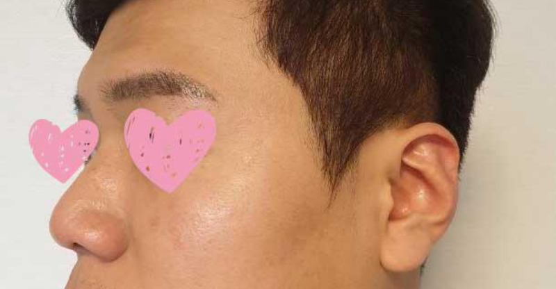 鼻樑、鼻頭、蒜頭鼻矯正、鷹鉤鼻