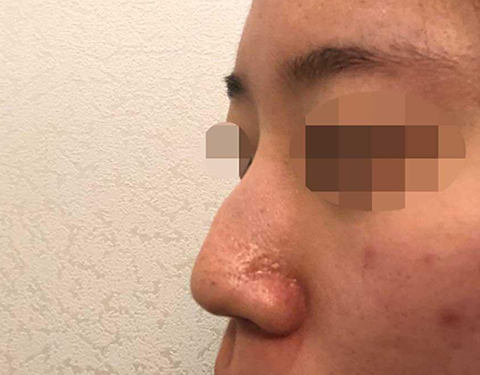 手術後4個月的後記!! ᄒᄒᄒ