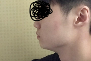 方下巴、顴骨縮小、皮質骨切除、下巴肉毒桿菌