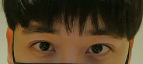 雙眼皮（切開）, 眼部矯正, 降低線條