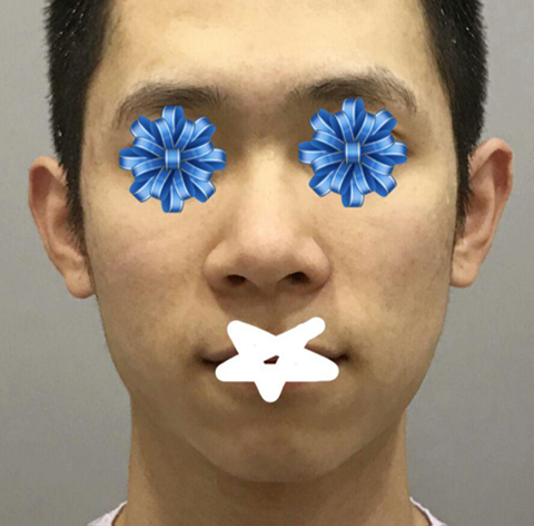 男士鼻子、輪廓整形後記