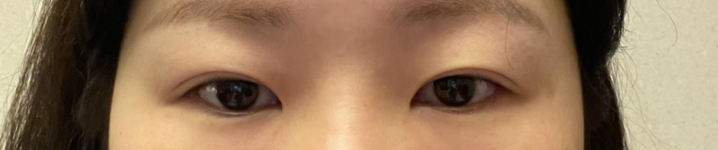 後眼角切開、下眼瞼下至、鼻部再手術（鼻樑、鼻尖）、短鼻矯正