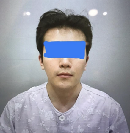 方下顎、顴骨縮小、下巴、皮質骨切除、維納斯雷射、輪廓注射