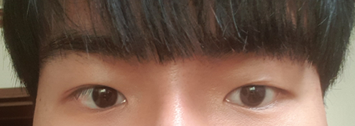 部分切開眼瞼下垂矯正修復手術