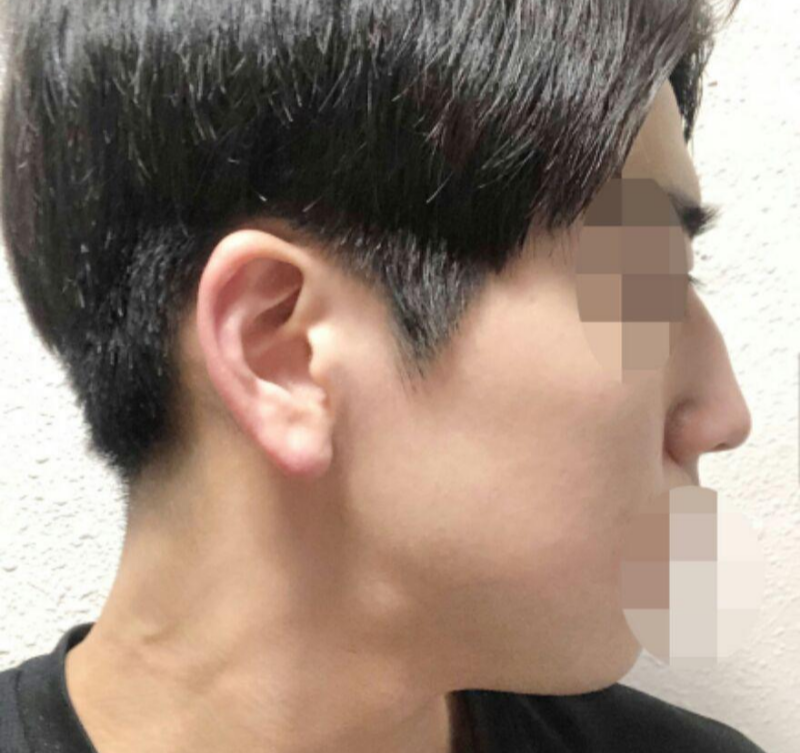 隆鼻、鼻頭、駝峰鼻、鼻骨縮小、蒜頭鼻矯正