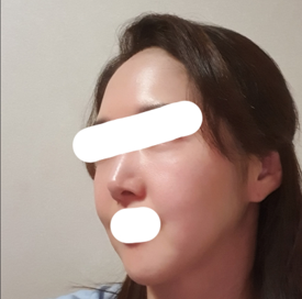 做了顏面拉皮重做手術，看到以前的照片很滿意^^