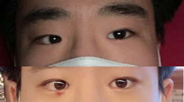 雙眼皮（縫雙眼皮）, 開眼頭