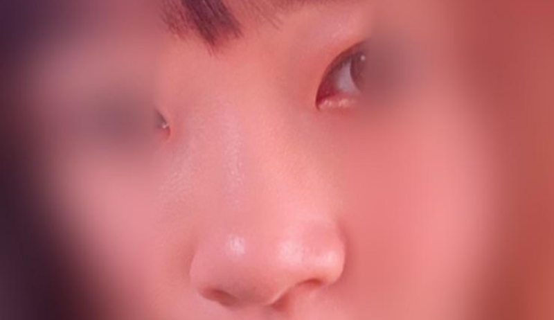 我在Jayjun整形外科打了鼻子填充劑:)