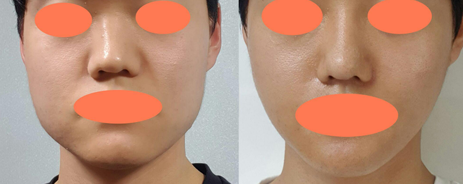 方下巴、皮質骨切除、咬肌縮小