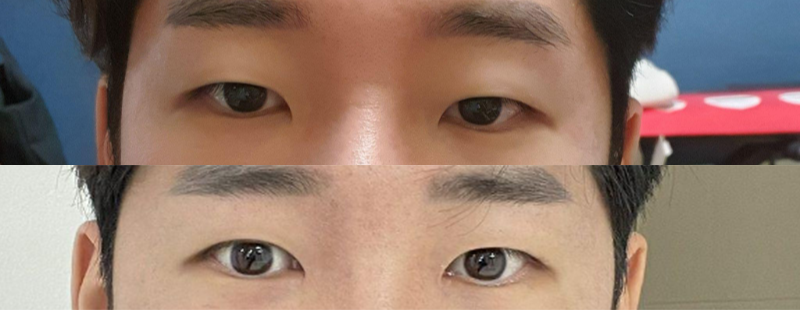 眼部矯正（部分切開）、開眼頭