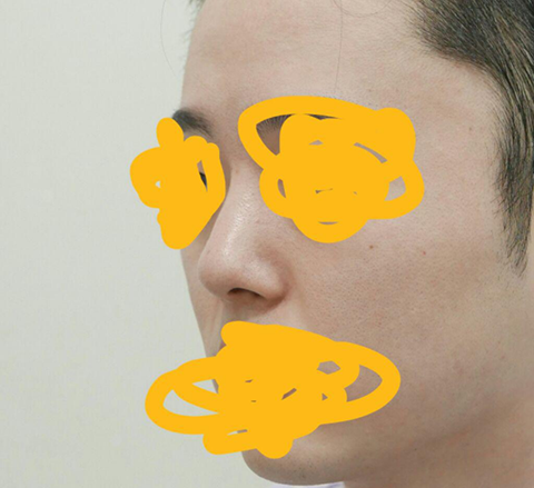 幾年前做的鼻子不滿意，所以在jayjun做了鼻部再造手術。
