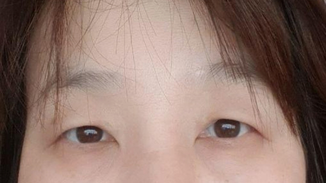 做了埋線雙眼皮、下眼瞼、上眼瞼手術