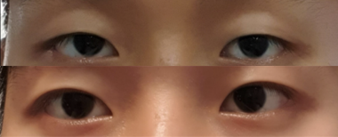 #非切開眼部整形