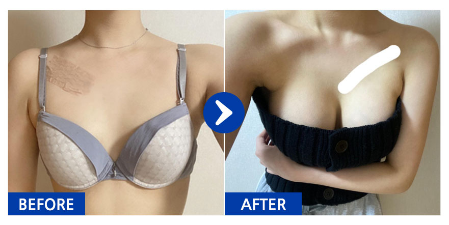 [바비톡] 가슴성형 / 6개월차 / 닉네임 : 멜룡