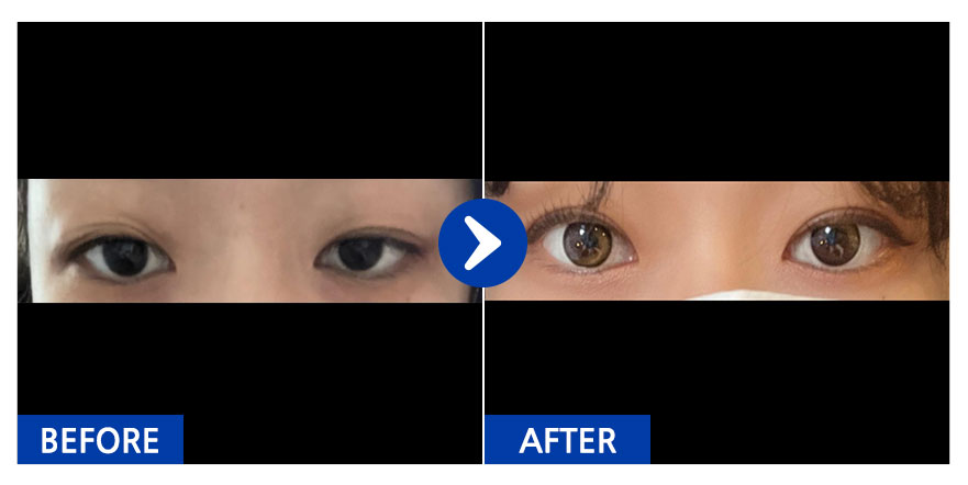 [강남언니] 쌍꺼풀(자연유착) / 2주차 / 닉네임 : 눈누난마난