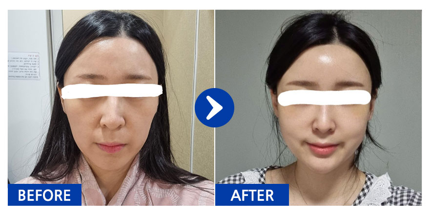 [바비톡] 지방이식 / 1개월차 / 닉네임 : 요요몬a