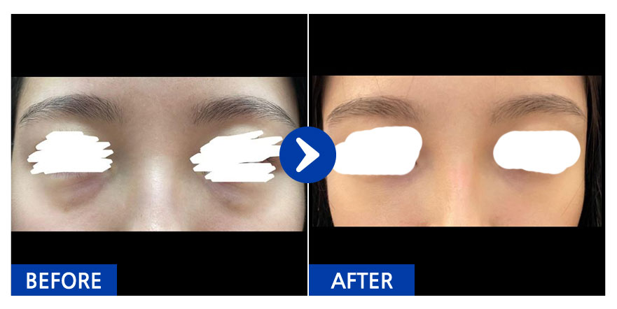 [바비톡] 눈밑지방재배치 / 1개월차 / 닉네임 : 슈슈슈슉슉