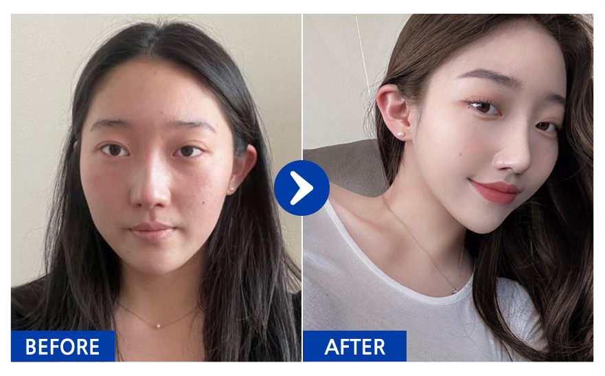 [바비톡] 코성형(기능코+미용코) / 2개월차 / 닉네임 : atmospe