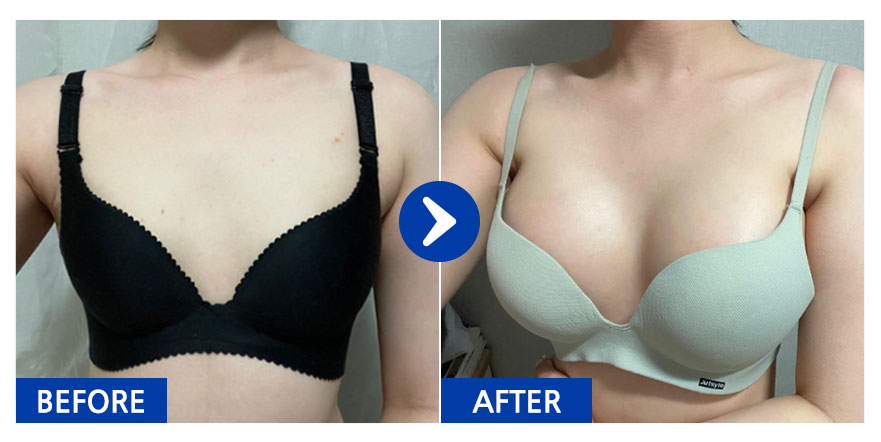 [바비톡] 가슴성형 / 1개월차/ 닉네임:스물네엣