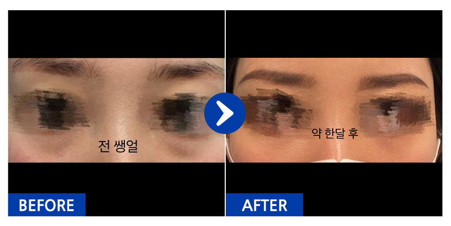 [강남언니] 눈밑지 / 1개월차 / 닉네임:쑈롱