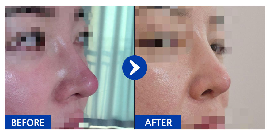 [바비톡] 코재수술 / 1개월차/ 닉네임: 코알라치치