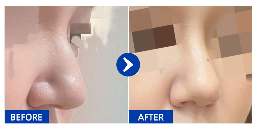 [강남언니] 코재수술 / 1개월차/ 닉네임: jjjejjj