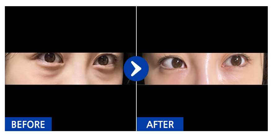 [강남언니] 눈밑지방재배치 7일차 / 닉네임: 동지금지