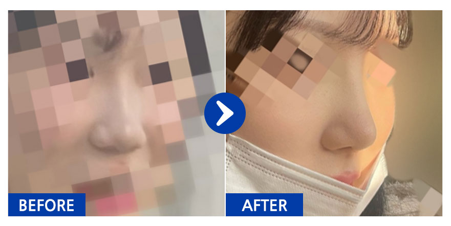 [강남언니] 코성형 1개월차 / 닉네임 : luckyyeji