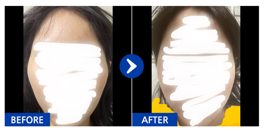 [강남언니] 광대 1개월차 / 닉네임 : qweasdfgh