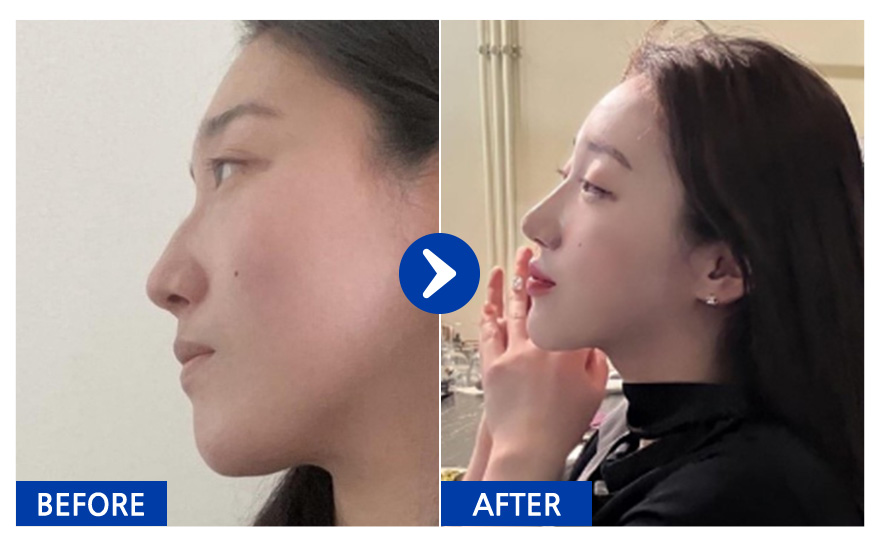 [바비톡] 코성형 1년차/ 닉네임:atmospe