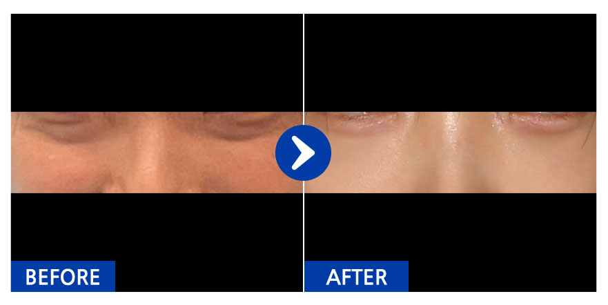 [강남언니] 눈밑지방재배치 1개월차 / 닉네임 : 미ㅣ미미미ㅣ